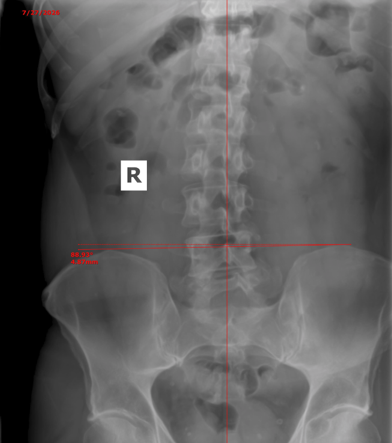 Tom pelvic X-ray — follow-up