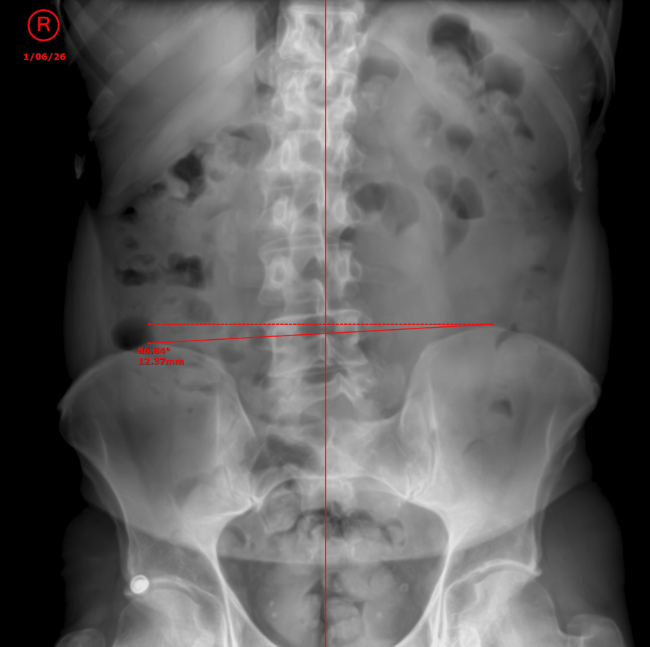 Tom pelvic X-ray — before