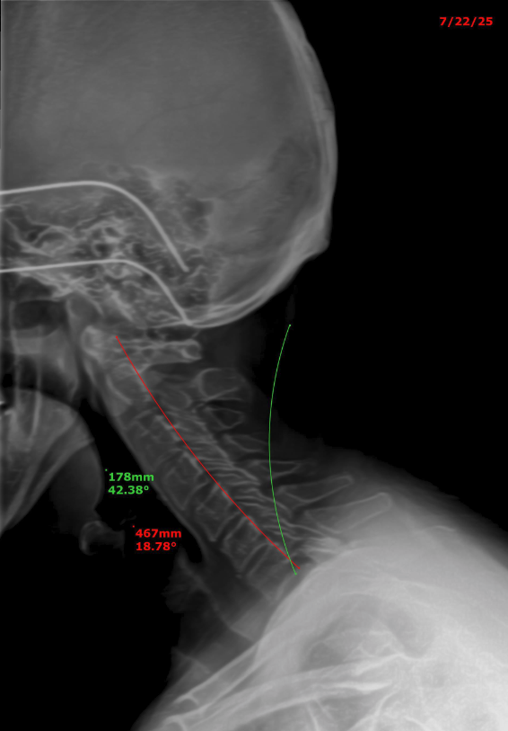 Doug cervical X-ray — before