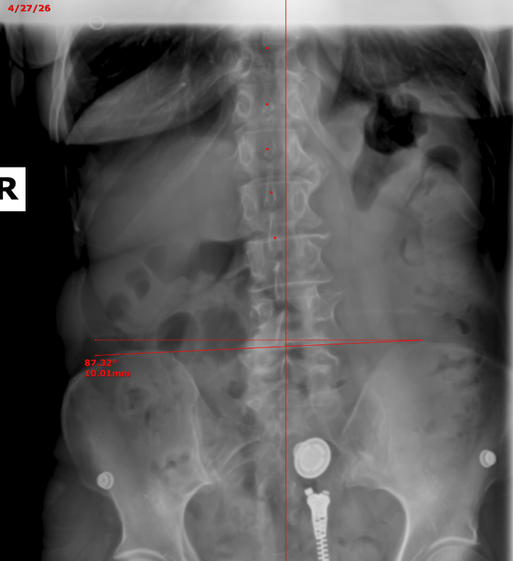 Tonya pelvic X-ray — before