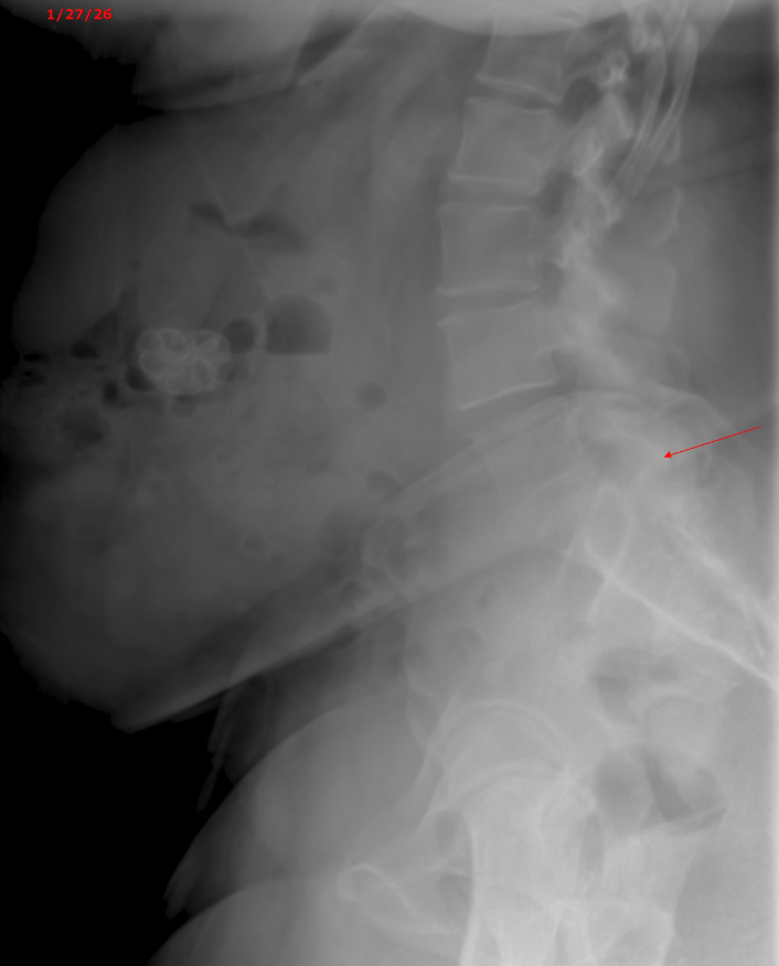 Trisha lumbar X-ray — before