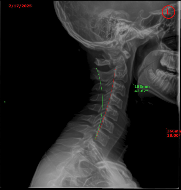 Gavin cervical X-ray — before
