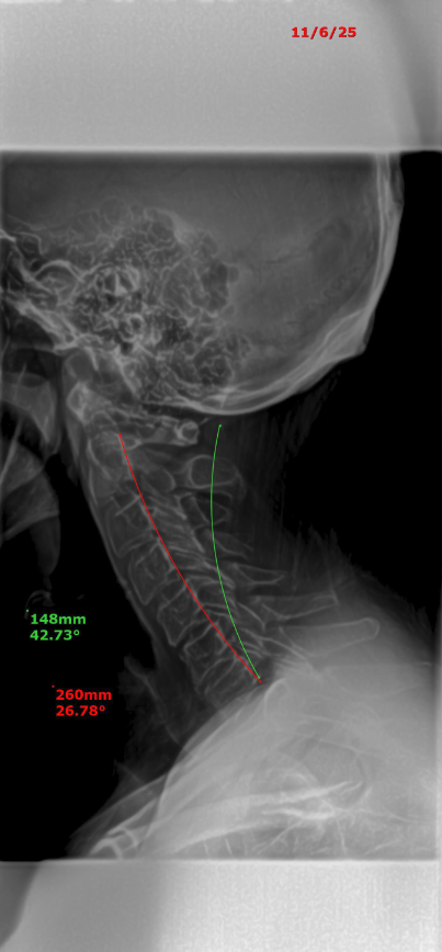 Doug cervical X-ray — follow-up