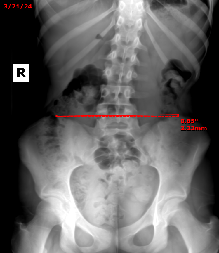 Mary full-spine X-ray — before