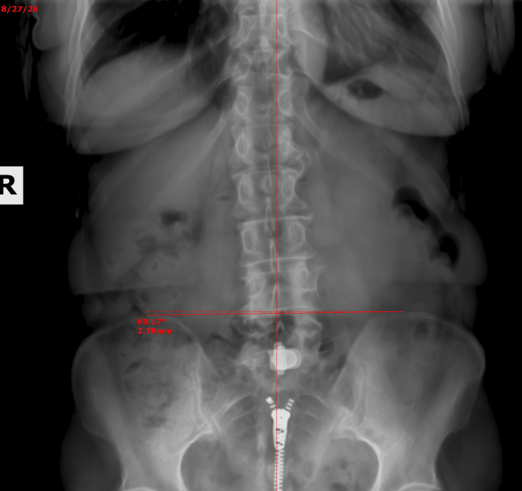 Tonya pelvic X-ray — follow-up