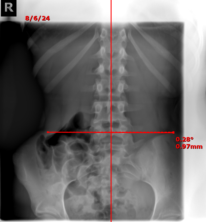 Mary full-spine X-ray — follow-up