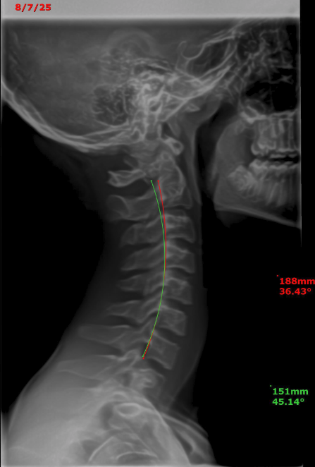 Gavin cervical X-ray — follow-up