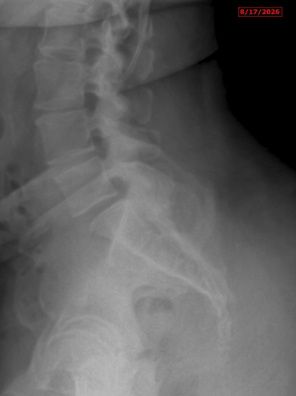 Trisha lumbar X-ray — follow-up